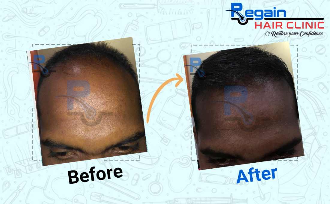 Regain Hair Transplant Clinic in Aurangabad | +91 95-95-94-95-77